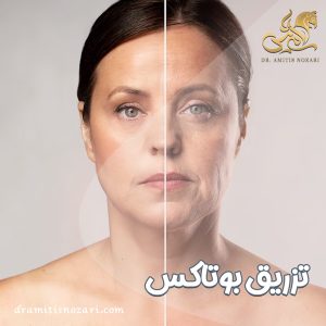 تزریق بوتاکس + دکتر آمی تیس نوذری