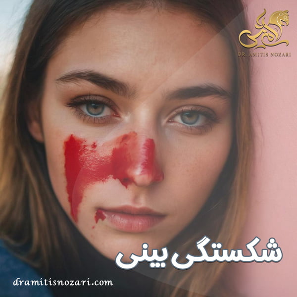 شکستگی بینی + دکتر آمی تیس نوذری