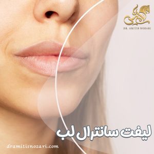 لیفت سانترال لب + دکتر آمی تیس نوذری