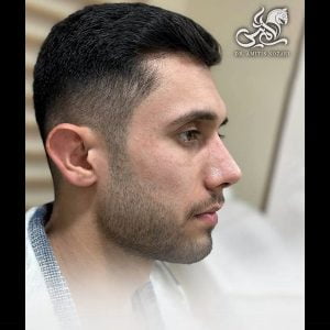 جراحی بینی طبیعی مردانه - دکتر آمی تیس نوذری