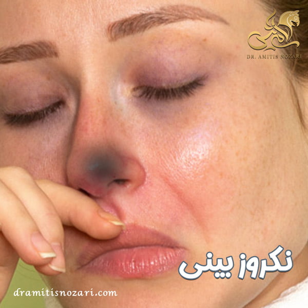 نکروز بینی - دکتر امی تیس نوذری