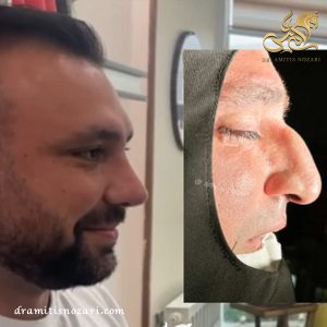 نمونه جراحی بینی مردانه 1- دکتر امی تیس نوذری 