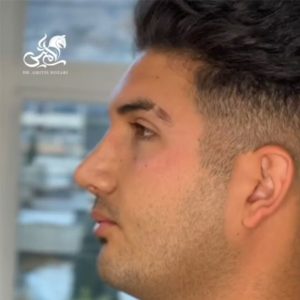 نمونه جراحی بینی مردانه 2 - دکتر امی تیس نوذری 