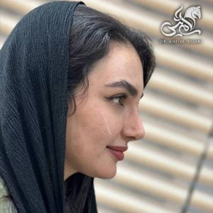 نمونه جراحی بینی 3 - دکتر امی تیس نوذری 