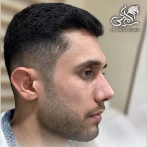 جراحی بینی 7 - دکتر آمی تیس نوذری