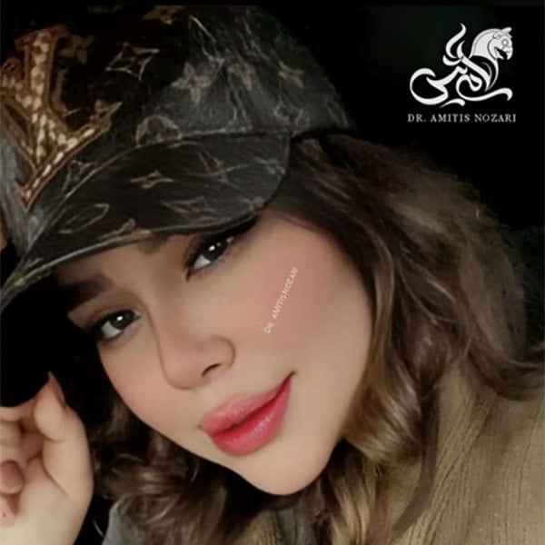 نمونه کار جراحی بینی گوشتی - دکتر آمی تیس نوذری