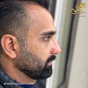 بهترین جراح بینی مردانه 2- دکتر نوذری 