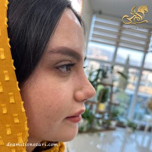 عمل بینی طبیعی در تهران 3