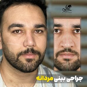 عمل بینی طبیعی در تهران 1