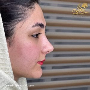 نمونه جراحی بینی 2 
