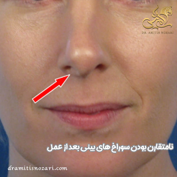 نامتقارن بودن سوراخ های بینی بعد از عمل - دکتر آمی تیس نوذری