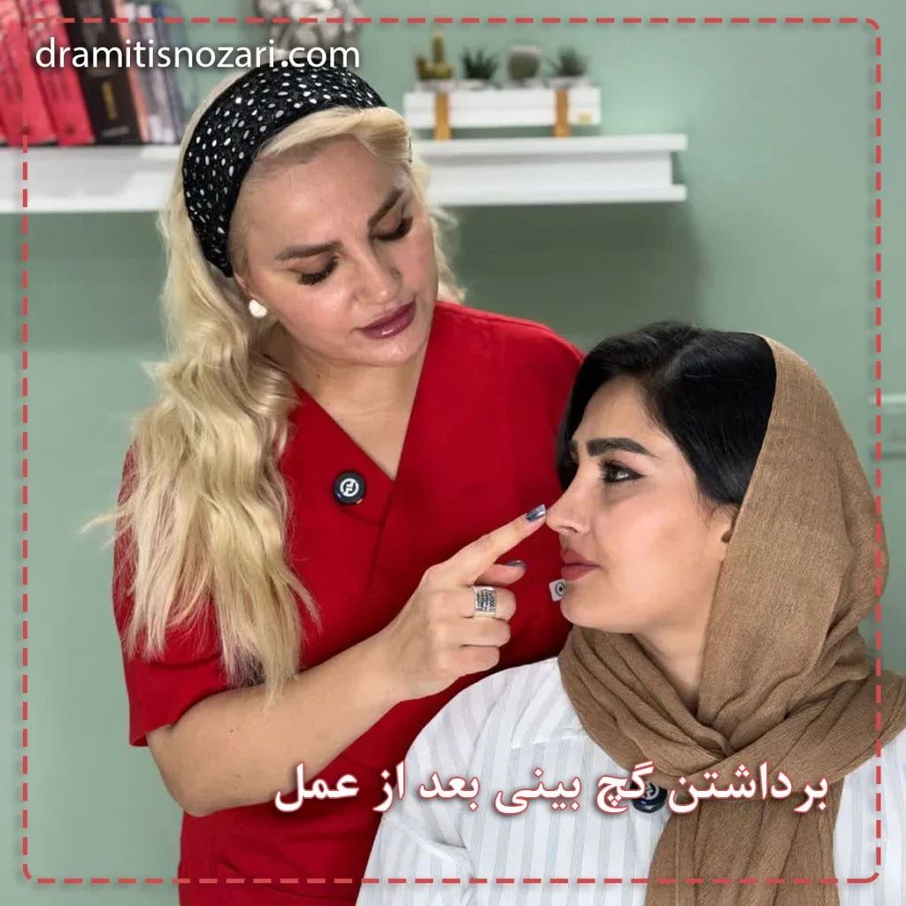 گچ بینی بعد از عمل- دکتر نوذری